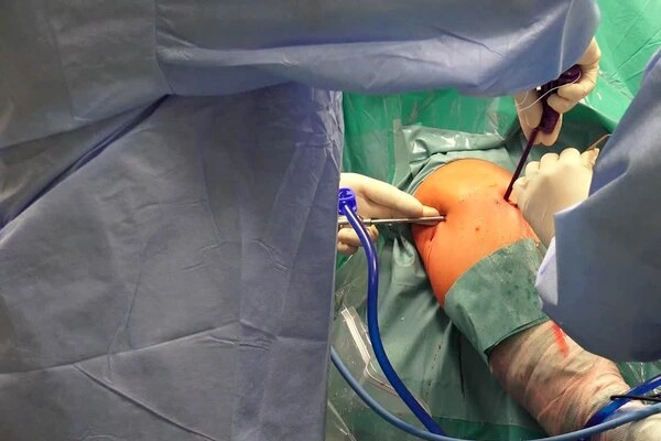 Arthroscopic Keyhole Surgery